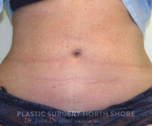 abdomin after liposuction