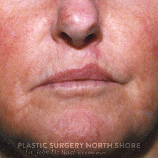 Lip Scar 1 Plastic Surgery North S.