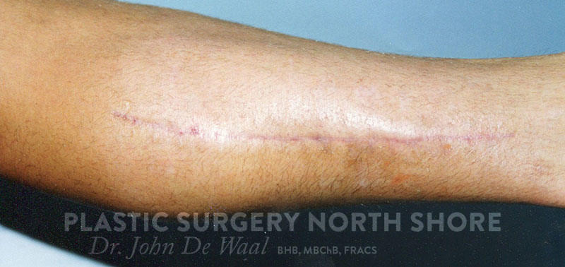 Leg scar 2 - Plastic Surgery North Shore